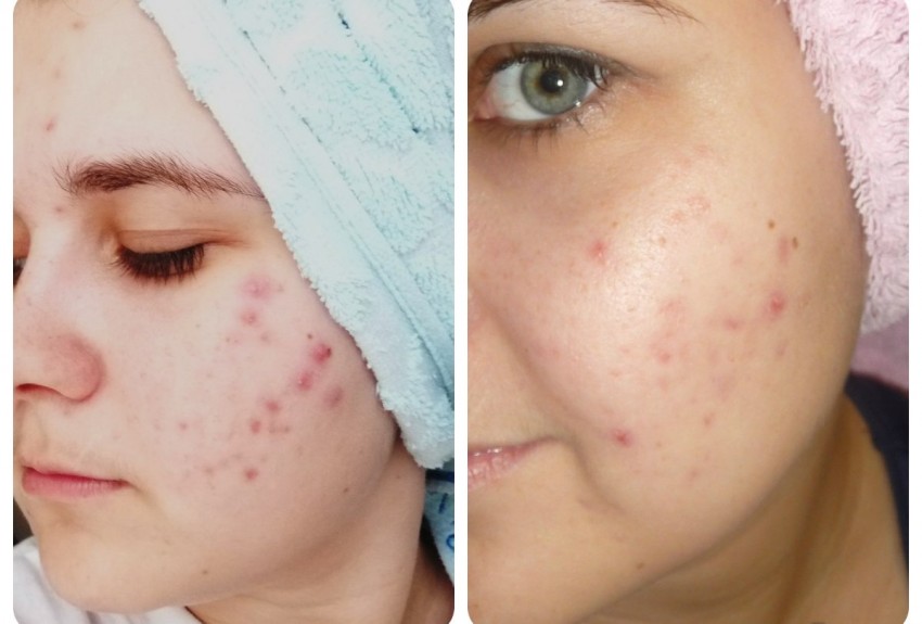 Гормональные прыщи: признаки и проявления, методы борьбы и ошибки при диагностике причины прыщей (105 фото + видео)