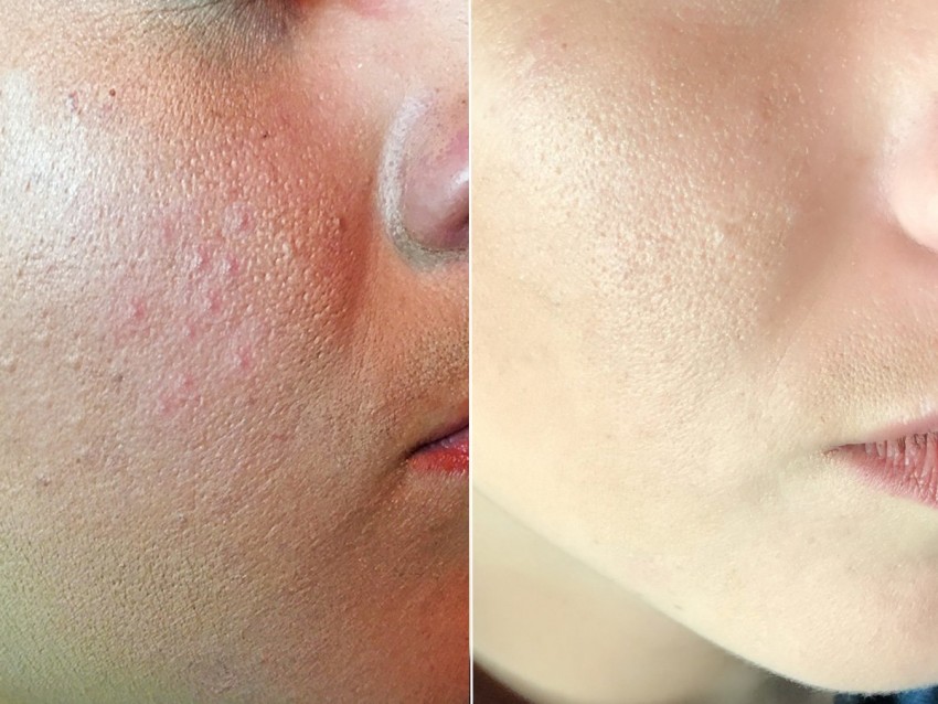 Гормональные прыщи: признаки и проявления, методы борьбы и ошибки при диагностике причины прыщей (105 фото + видео)