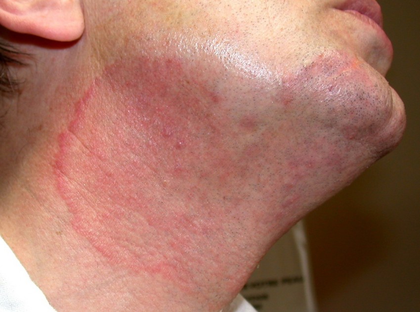 Грибок кожи: симптомы, виды, этапы возникновения и первые признаки. Лечение и профилактика заболевания (85 фото + видео)