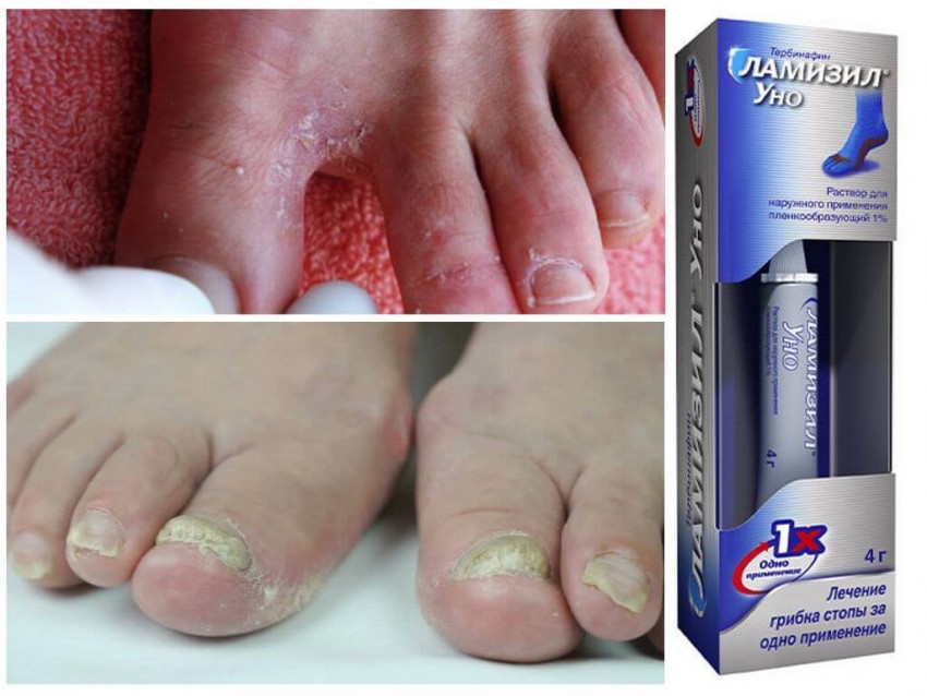 Грибок кожи: симптомы, виды, этапы возникновения и первые признаки. Лечение и профилактика заболевания (85 фото + видео)