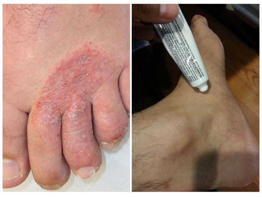 Грибок кожи: симптомы, виды, этапы возникновения и первые признаки. Лечение и профилактика заболевания (85 фото + видео)