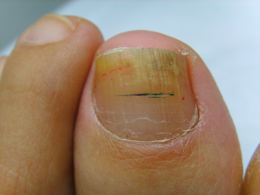 Грибок ногтей - какой врач лечит, основные признаки. Профилактика заболевания, 110 фото и видео восстановления ногтей