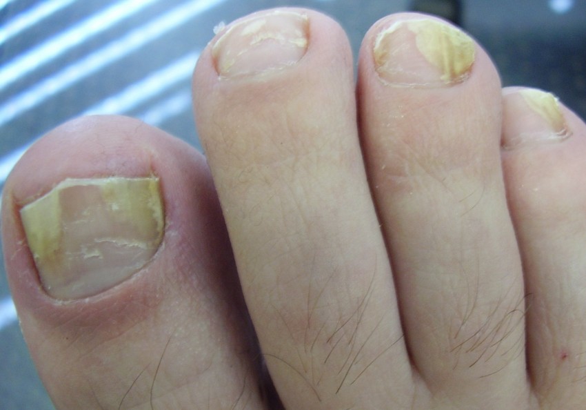 Грибок стопы - симптомы, варианты эффективного лечения, причины появления и развития болезни (105 фото и видео)