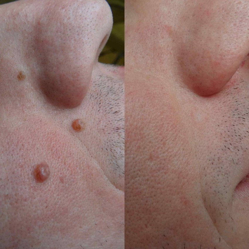 Хорошие родинки - как проверить и удалить родинку на лице и на теле. Советы экспертов по определению опасная или нет родинка (115 фото и видео)