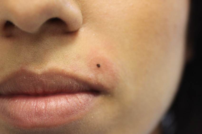 Хорошие родинки - как проверить и удалить родинку на лице и на теле. Советы экспертов по определению опасная или нет родинка (115 фото и видео)