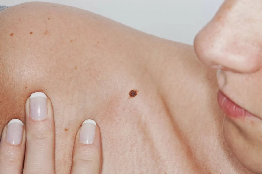 Хорошие родинки - как проверить и удалить родинку на лице и на теле. Советы экспертов по определению опасная или нет родинка (115 фото и видео)