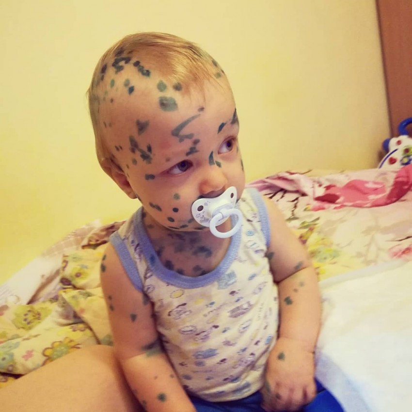 Инкубационный период ветрянки: количество дней, заразность и особенности протекания у детей и взрослых (115 фото)