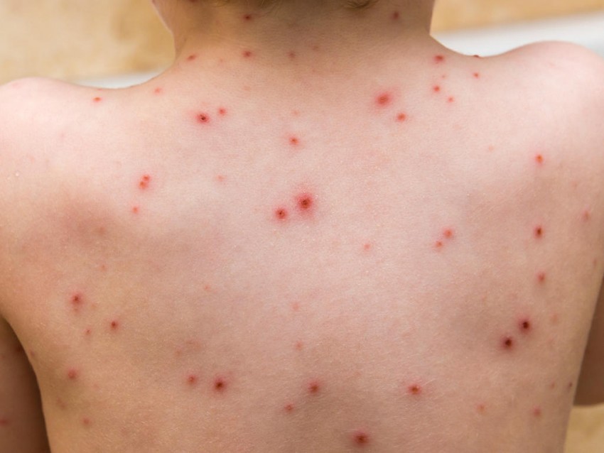 Инкубационный период ветрянки: количество дней, заразность и особенности протекания у детей и взрослых (115 фото)