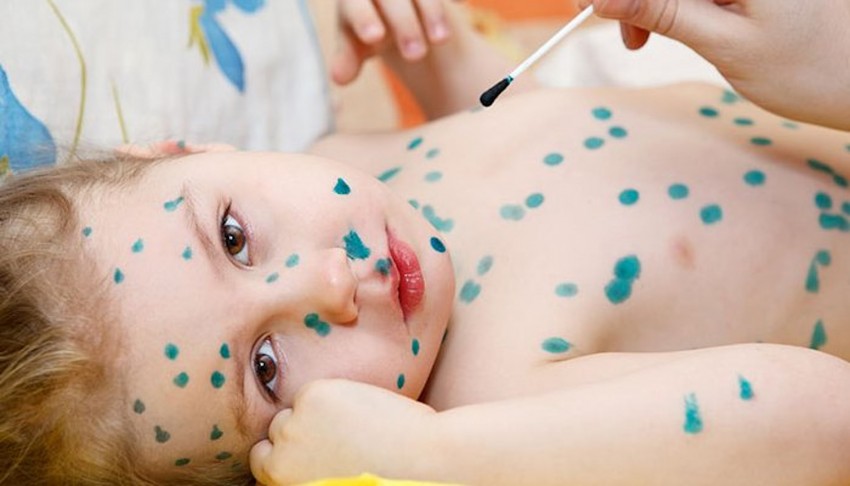 Инкубационный период ветрянки: количество дней, заразность и особенности протекания у детей и взрослых (115 фото)