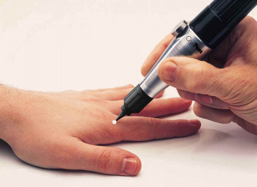 Как избавиться от бородавок: варианты и методы современного удаления бородавок. Видео и фото описание этапов удаления бородавок