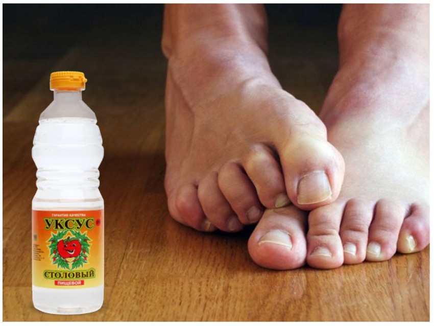 Как избавиться от бородавок: варианты и методы современного удаления бородавок. Видео и фото описание этапов удаления бородавок