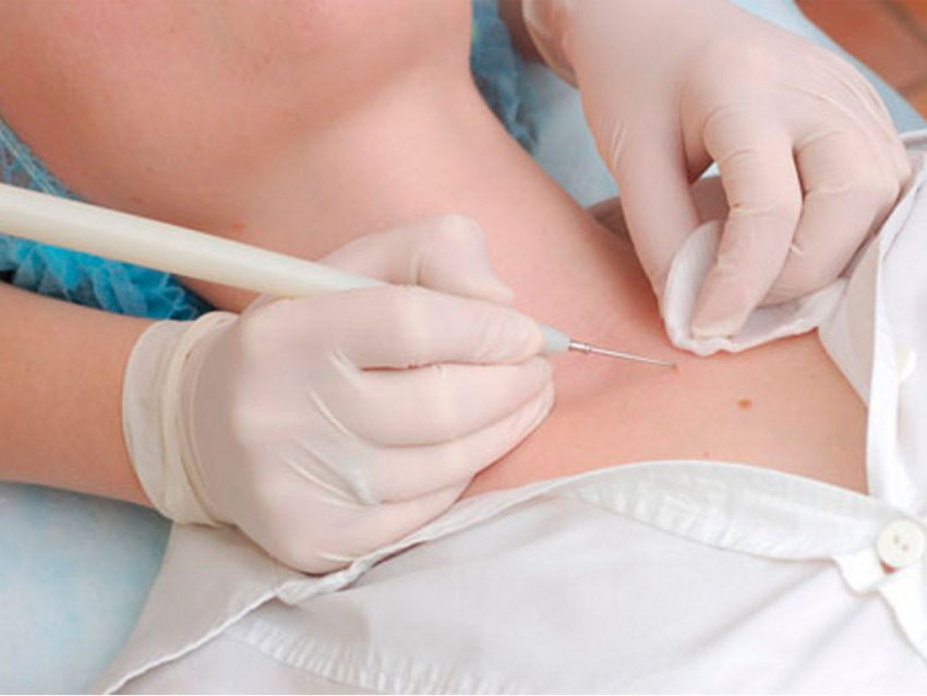 Как избавиться от бородавок: варианты и методы современного удаления бородавок. Видео и фото описание этапов удаления бородавок