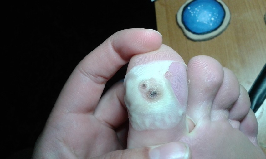 Как избавиться от бородавок: варианты и методы современного удаления бородавок. Видео и фото описание этапов удаления бородавок