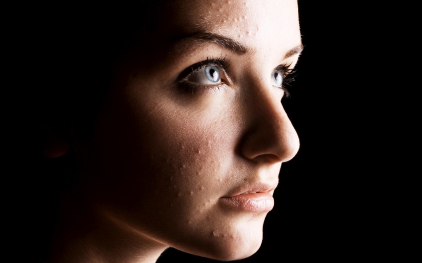 Как избавиться от прыщей - лучшие средства, советы дерматологов и рекомендации по уходу за кожей (85 фото)