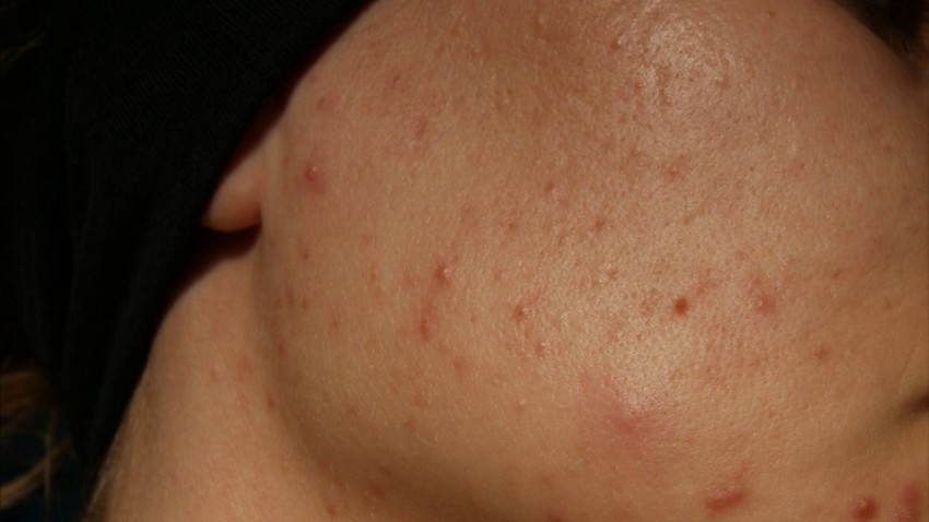 Как избавиться от прыщей - лучшие средства, советы дерматологов и рекомендации по уходу за кожей (85 фото)