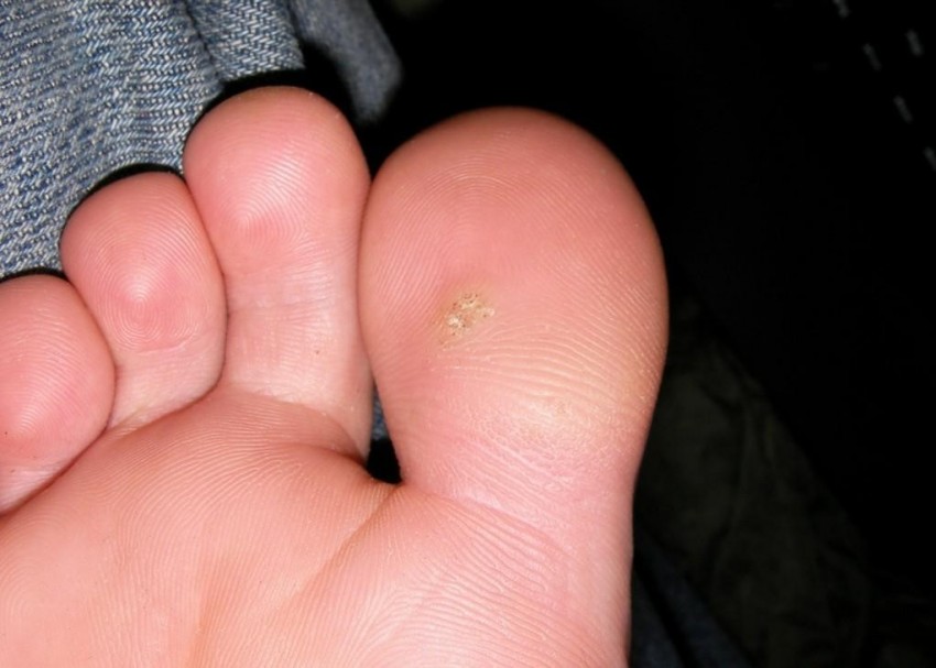 Как убрать бородавку: самые эффективные народные и медицинские средства по удалению бородавок своими руками (125 фото и видео)