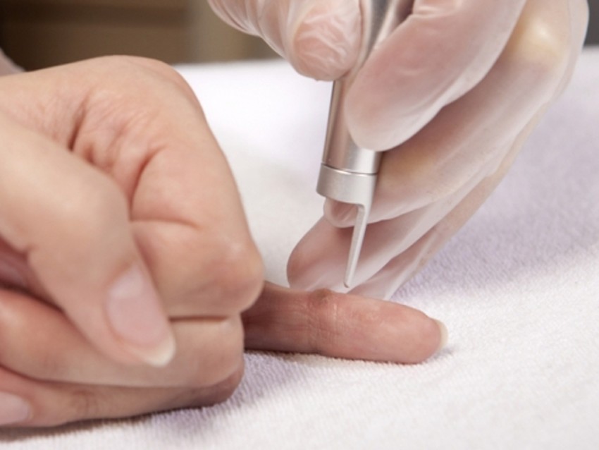 Как убрать бородавку: самые эффективные народные и медицинские средства по удалению бородавок своими руками (125 фото и видео)