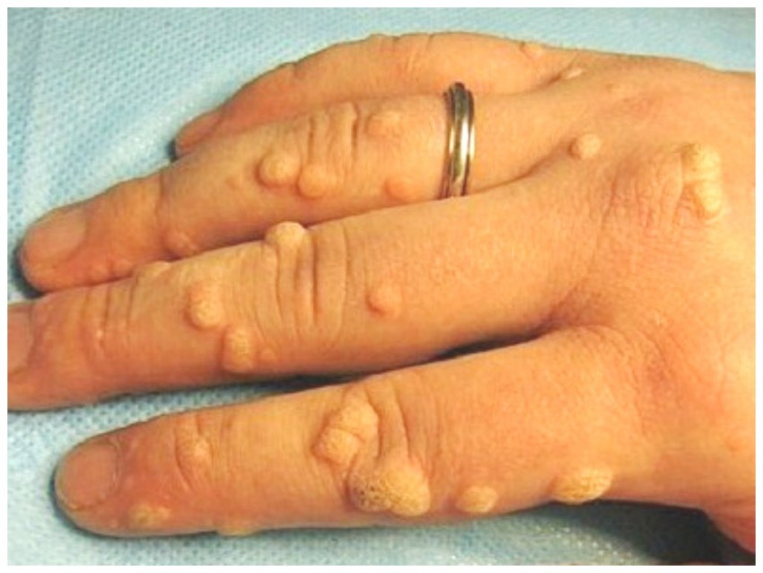 Как убрать бородавку: самые эффективные народные и медицинские средства по удалению бородавок своими руками (125 фото и видео)