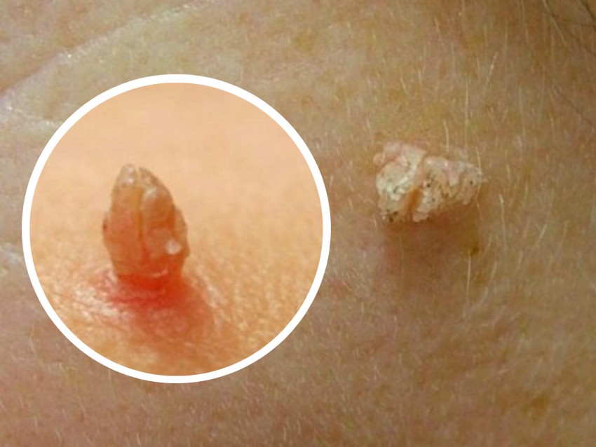 Как выглядит бородавка - 150 фото разновидностей, структура и описание свойств характерных наросту