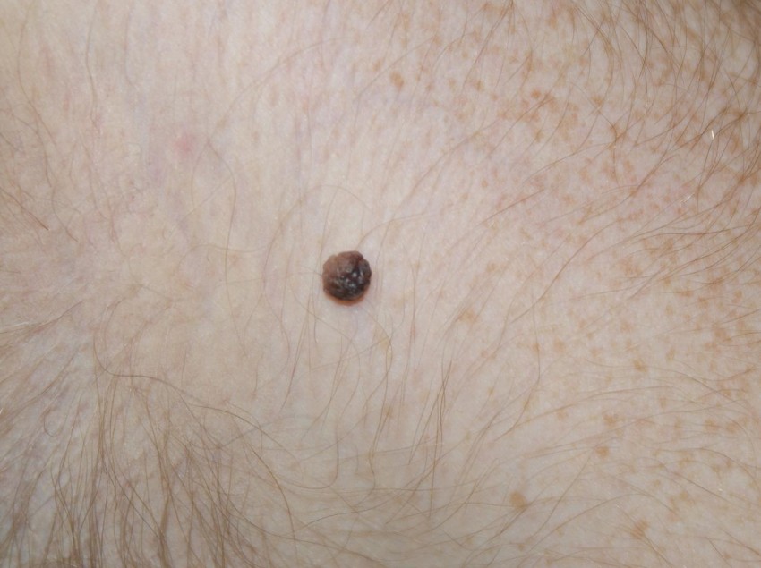 Как выглядит бородавка - 150 фото разновидностей, структура и описание свойств характерных наросту