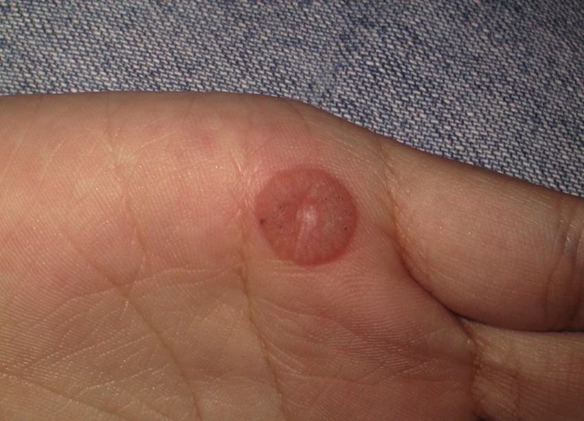 Как выглядит бородавка - 150 фото разновидностей, структура и описание свойств характерных наросту