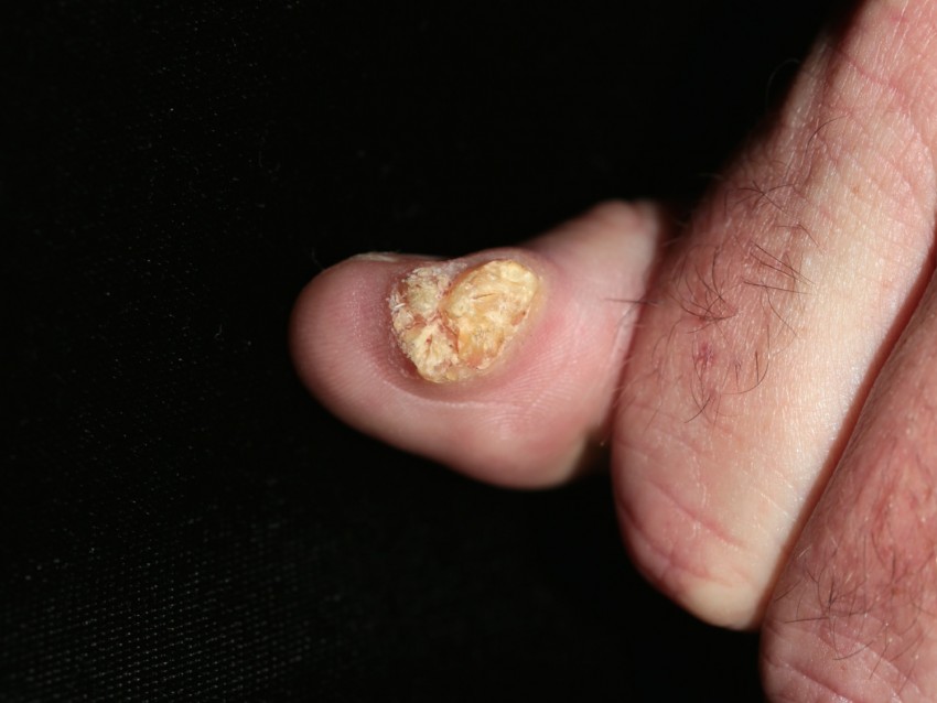 Как выглядит бородавка - 150 фото разновидностей, структура и описание свойств характерных наросту
