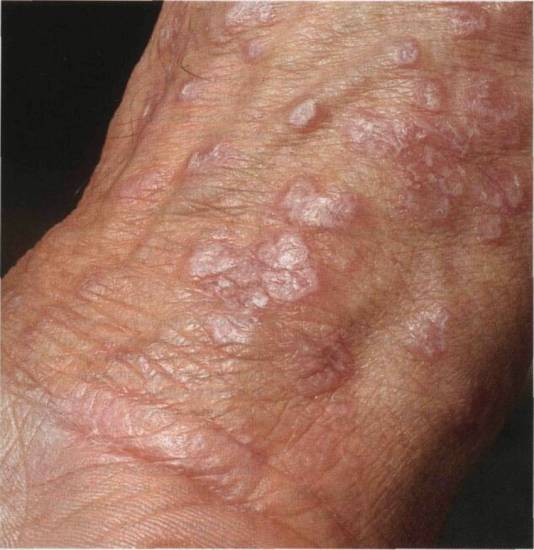 Как выглядит лишай: 130 фото основных видов и форм заболевания. Видео рекомендации по лечению разных стадий болезни