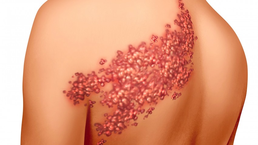 Как выглядит лишай: 130 фото основных видов и форм заболевания. Видео рекомендации по лечению разных стадий болезни