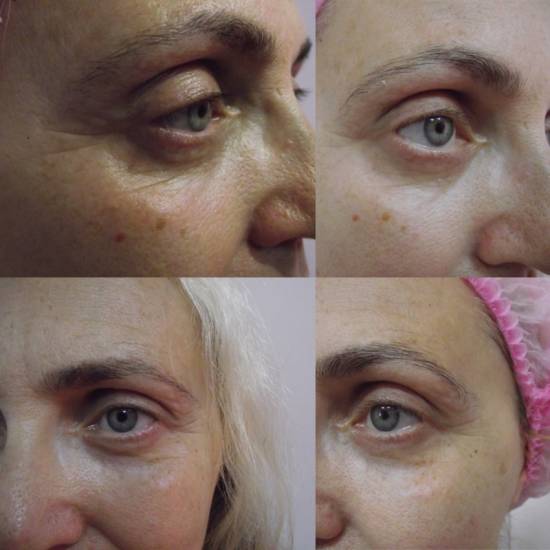 Карбокситерапия: показания, противопоказания к назначению. 125 фото и видео описание процедуры