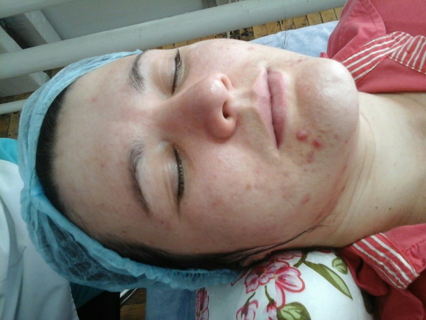 Карбокситерапия: показания, противопоказания к назначению. 125 фото и видео описание процедуры