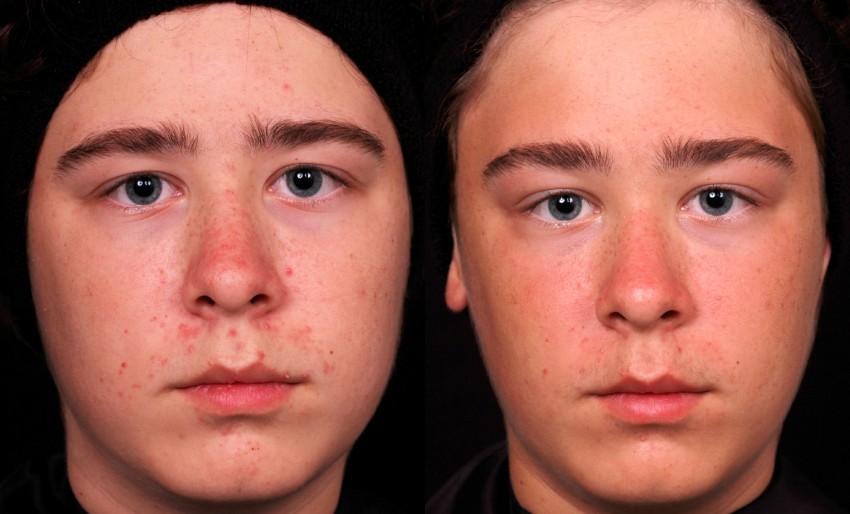 Кислотный пилинг: показания, противопоказания и советы косметологов по применению химического пилинга (105 фото)