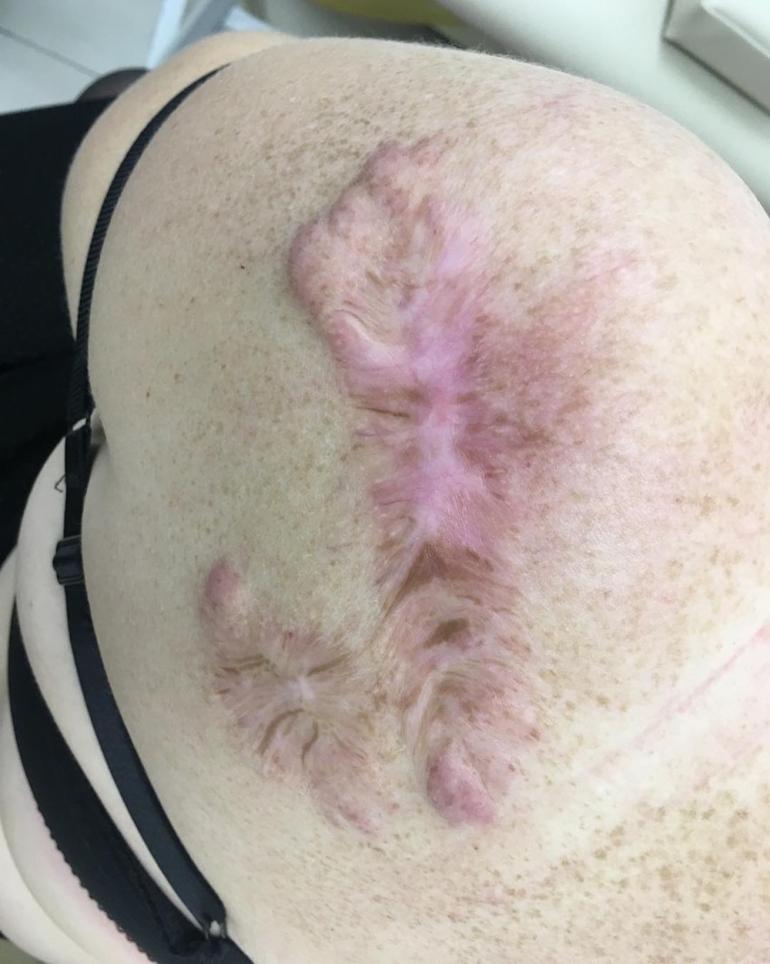 Коллоидные рубцы: 120 фото, причины появления, варианты лечения, виды кожной болезни, средства и способы устранения рубца