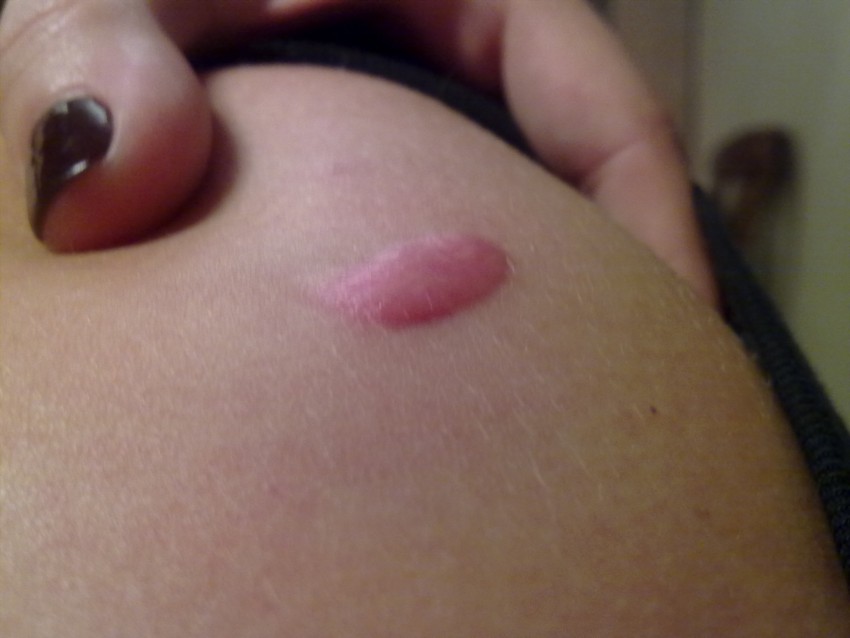 Коллоидные рубцы: 120 фото, причины появления, варианты лечения, виды кожной болезни, средства и способы устранения рубца