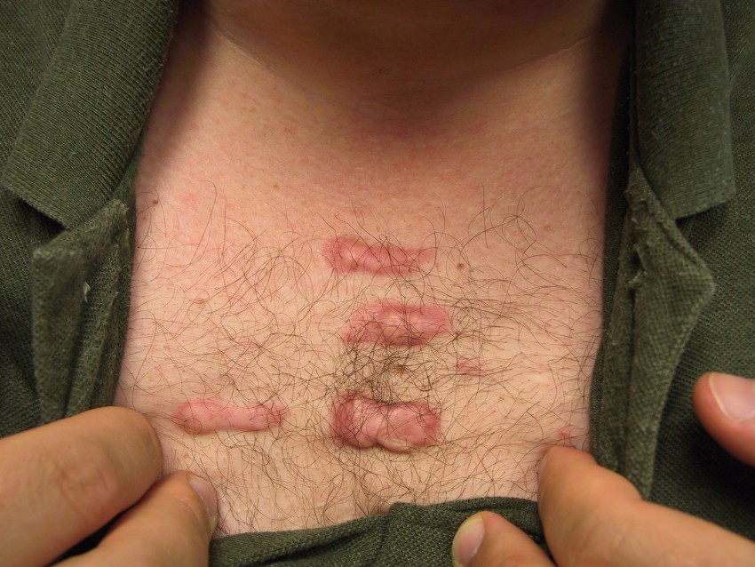 Коллоидные рубцы: 120 фото, причины появления, варианты лечения, виды кожной болезни, средства и способы устранения рубца