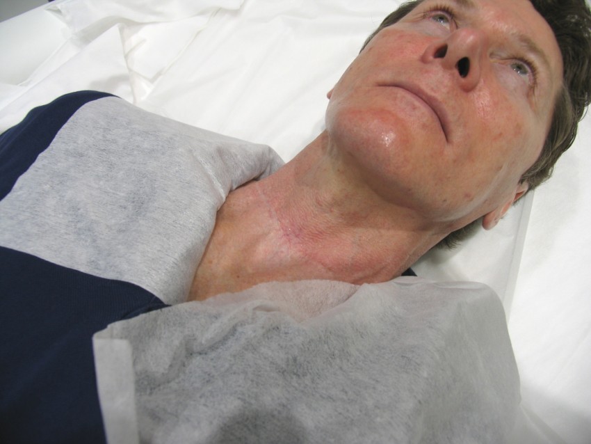 Коллоидные рубцы: 120 фото, причины появления, варианты лечения, виды кожной болезни, средства и способы устранения рубца