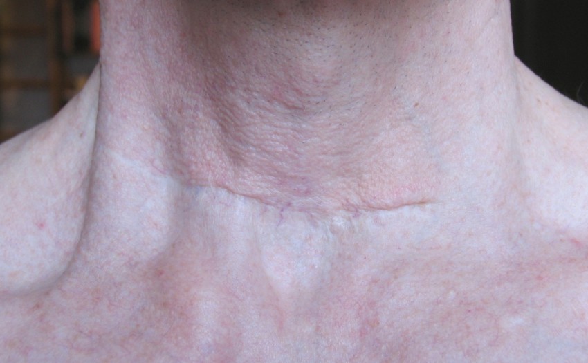 Коллоидные рубцы: 120 фото, причины появления, варианты лечения, виды кожной болезни, средства и способы устранения рубца