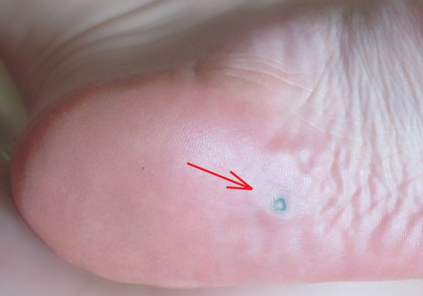 Корень бородавки - строение, образование и удаление. Подробное описание корня и методы избавления бородавки с корнем (85 фото)