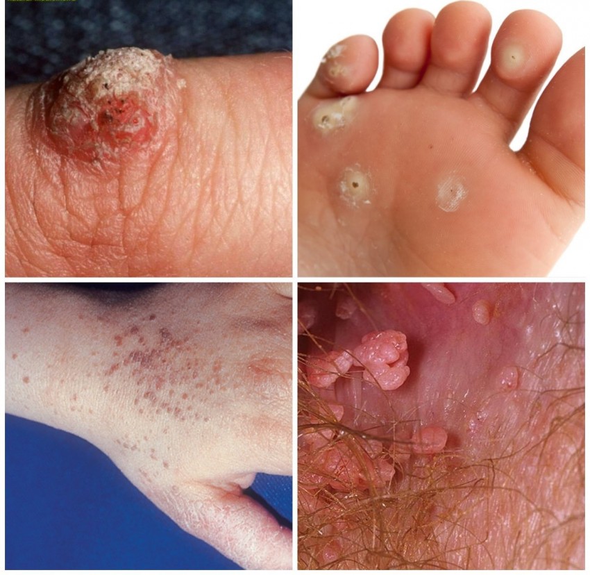 Корень бородавки - строение, образование и удаление. Подробное описание корня и методы избавления бородавки с корнем (85 фото)