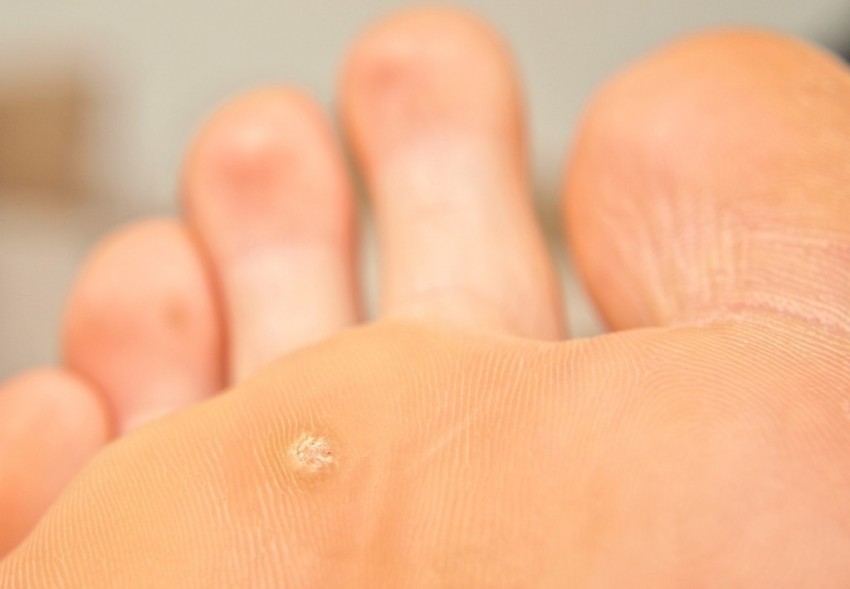 Корень бородавки - строение, образование и удаление. Подробное описание корня и методы избавления бородавки с корнем (85 фото)