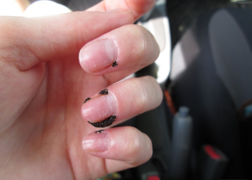 Корень бородавки - строение, образование и удаление. Подробное описание корня и методы избавления бородавки с корнем (85 фото)