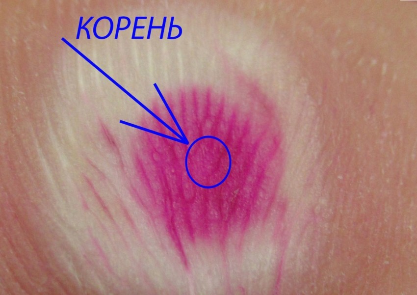 Корень бородавки - строение, образование и удаление. Подробное описание корня и методы избавления бородавки с корнем (85 фото)