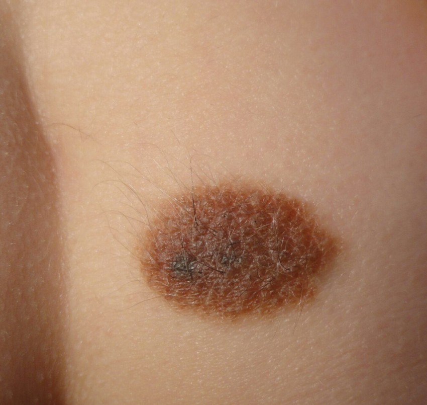 Коричневая родинка - опасная или нет? Как определить самостоятельно и к какому врачу обращаться для удаления (110 фото)