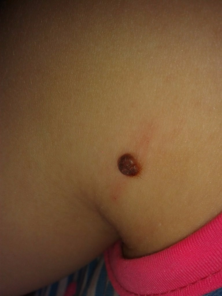 Коричневая родинка - опасная или нет? Как определить самостоятельно и к какому врачу обращаться для удаления (110 фото)