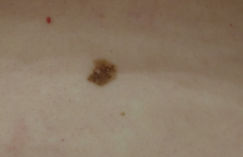 Коричневая родинка - опасная или нет? Как определить самостоятельно и к какому врачу обращаться для удаления (110 фото)