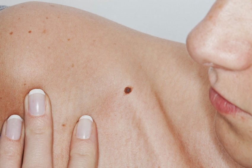 Коричневая родинка - опасная или нет? Как определить самостоятельно и к какому врачу обращаться для удаления (110 фото)