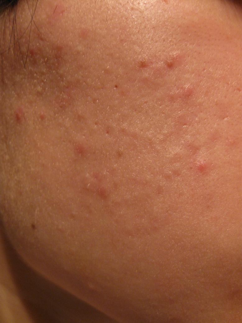 Красные прыщи - обзор лучших средств и самых эффективных методов избавления от прыщей (75 фото + видео)