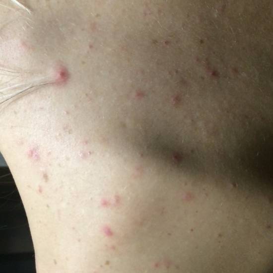 Красные прыщи - обзор лучших средств и самых эффективных методов избавления от прыщей (75 фото + видео)