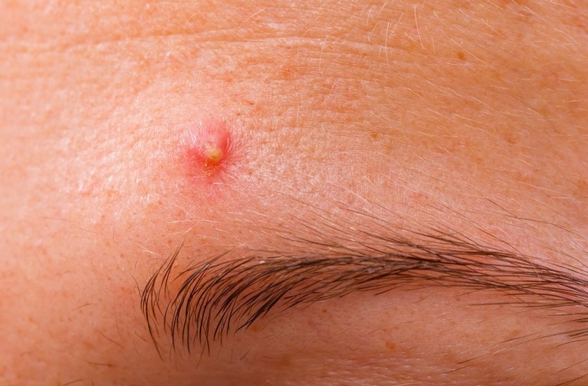 Красные прыщи - обзор лучших средств и самых эффективных методов избавления от прыщей (75 фото + видео)