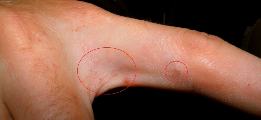 Красные прыщи - обзор лучших средств и самых эффективных методов избавления от прыщей (75 фото + видео)