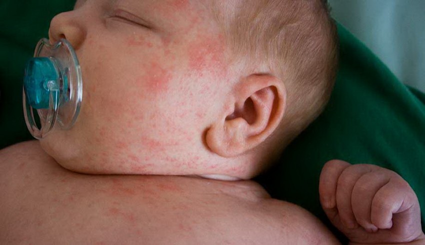 Красные прыщи - обзор лучших средств и самых эффективных методов избавления от прыщей (75 фото + видео)